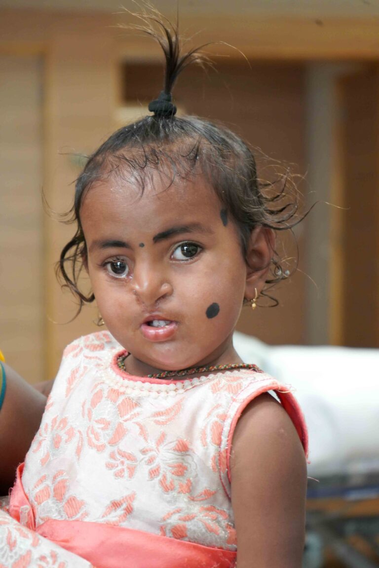 Baby with ‘Tessier Facial Cleft’ gets complete face reconstruction at Aster CMI Hospital
